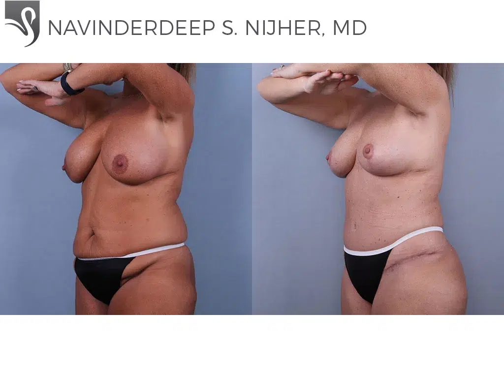 Before and After Image: Abdominoplasty (Tummy Tuck) Case #74532 - left-front-oblique