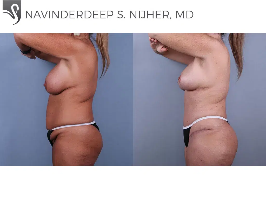 Before and After Image: Abdominoplasty (Tummy Tuck) Case #74532 - left-side