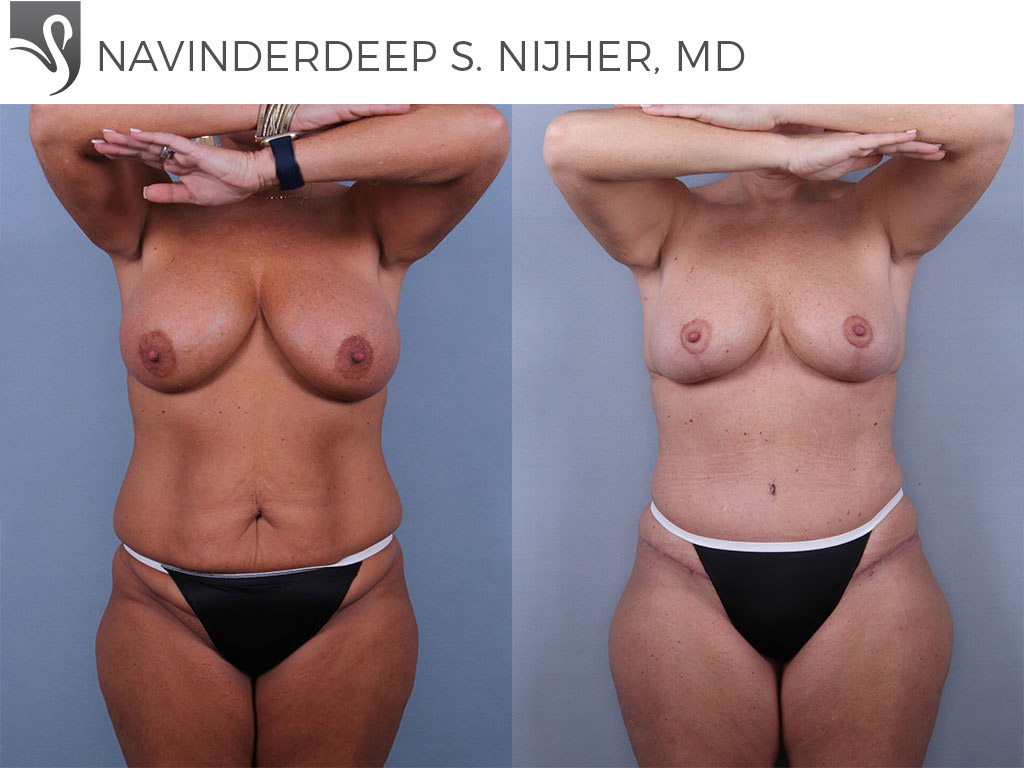 Before and After Image: Mommy Makeover Case #74532