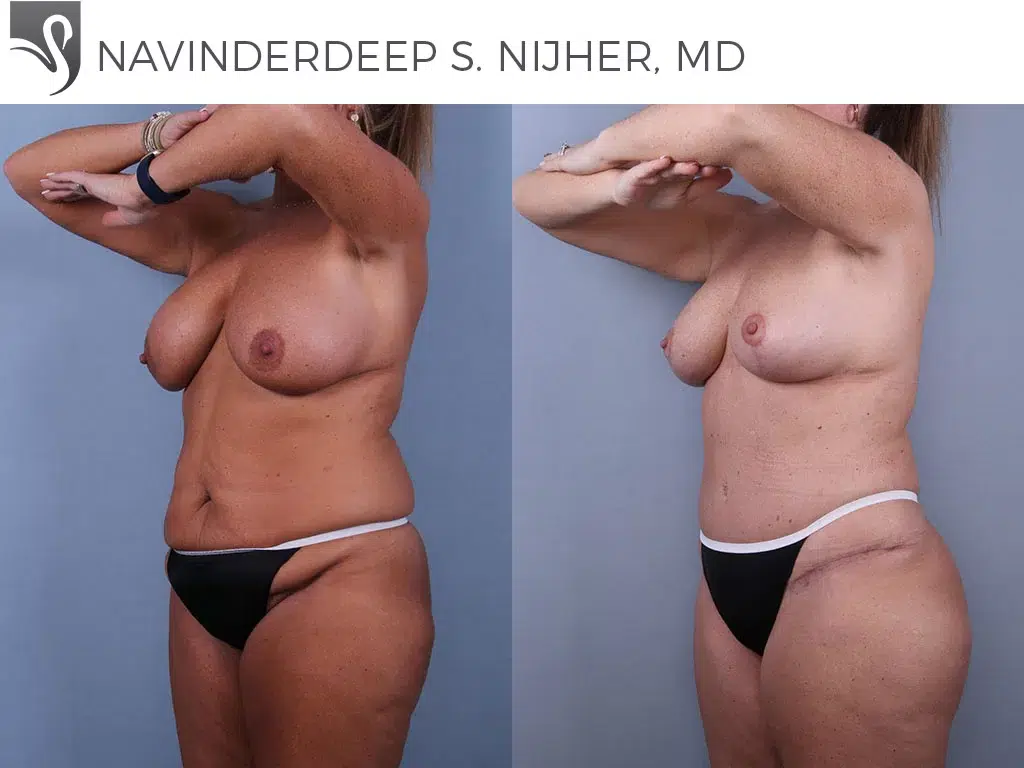 Before and After Image: Mommy Makeover Case #74532 - left-front-oblique