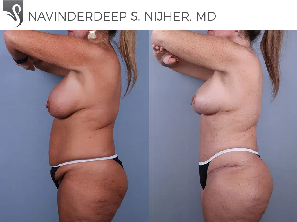 Before and After Image: Mommy Makeover Case #74532 - left-side