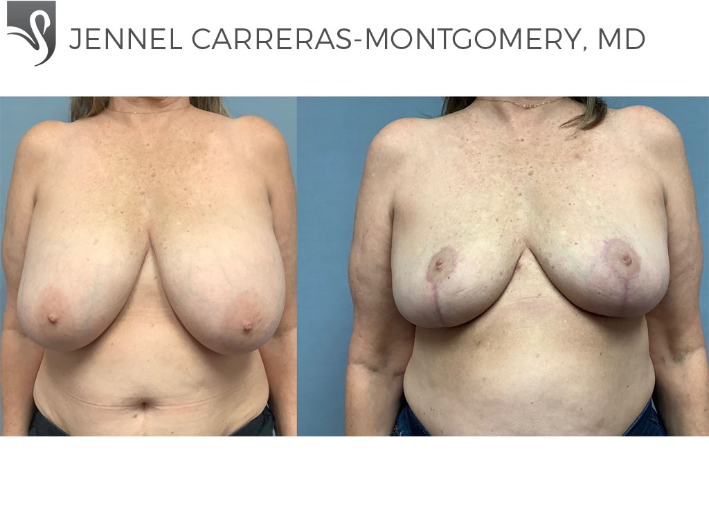 Before and After Image: Female Breast Reduction Case #74683 - front