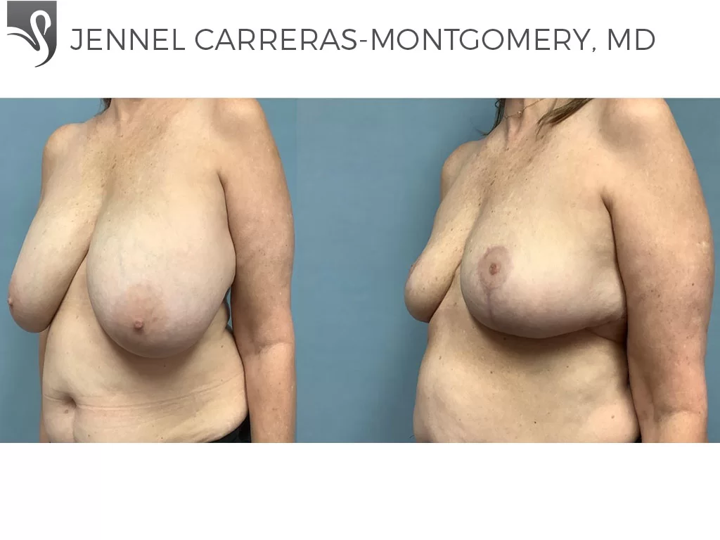 Before and After Image: Female Breast Reduction Case #74683 - left-front-oblique