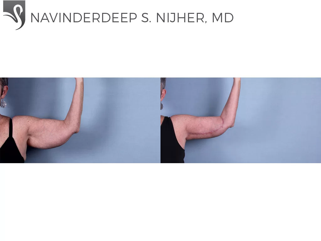 Before and After Image: Arm Lift Case #74720 - front