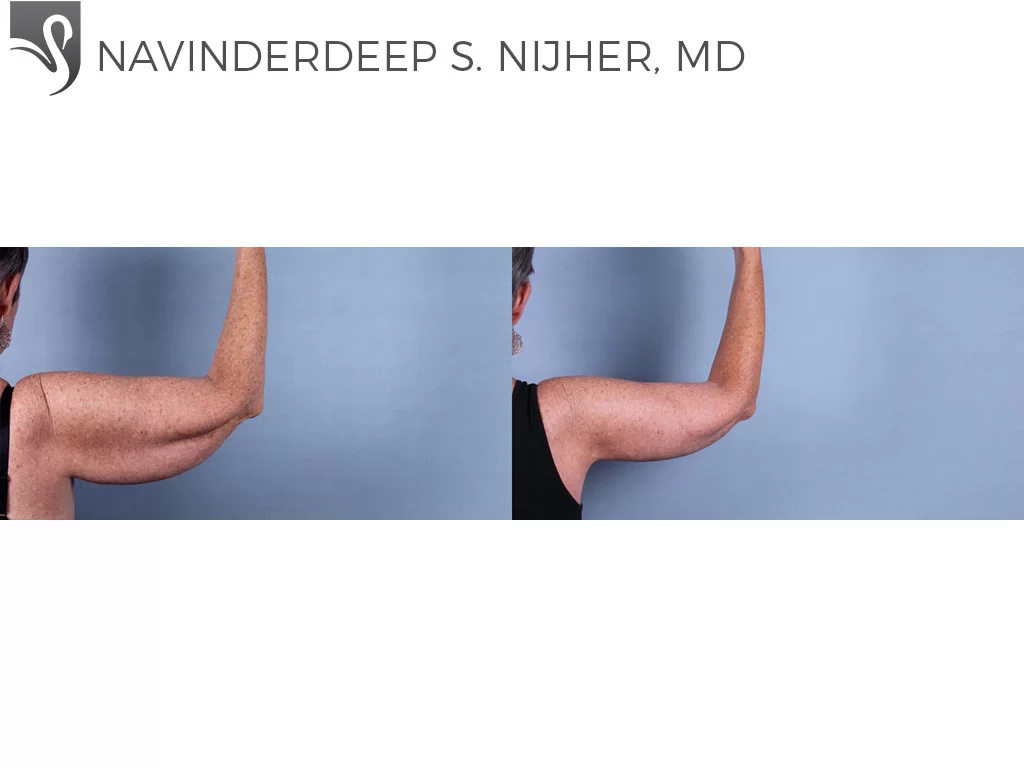 Before and After Image: Arm Lift Case #74720 - back