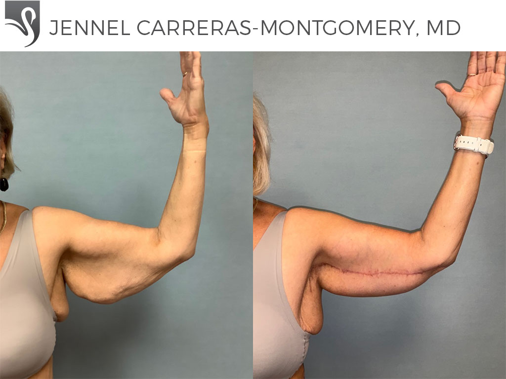 Before and After Image: Arm Lift Case #74728 - front