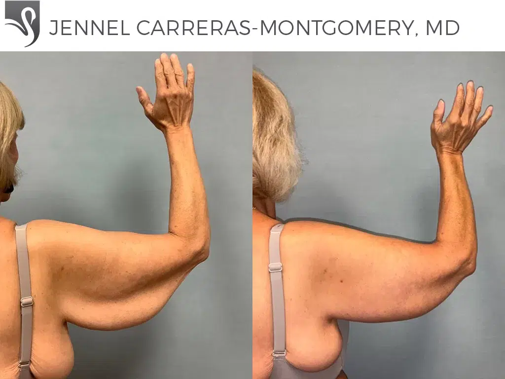 Before and After Image: Arm Lift Case #74728 - back