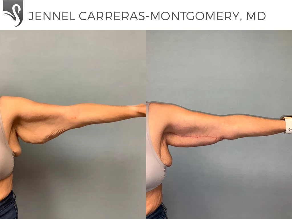 Before and After Image: Arm Lift Case #74728 - front