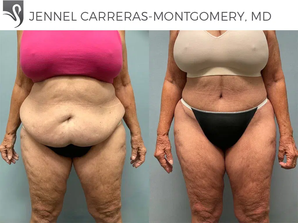 Before and After Image: Post-Bariatric Surgery Case #74911 - front
