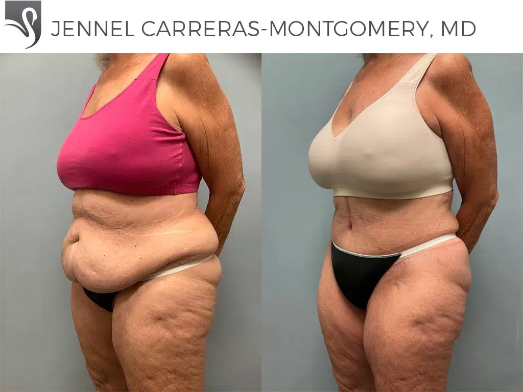 Before and After Image: Post-Bariatric Surgery Case #74911 - left-front-oblique