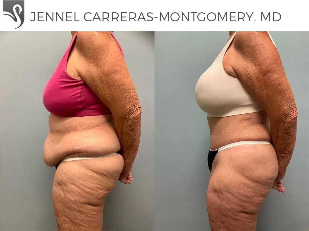 Before and After Image: Post-Bariatric Surgery Case #74911 - left-side