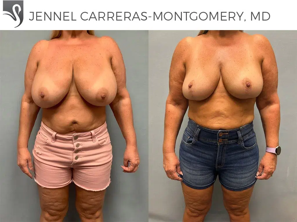 Before and After Image: Female Breast Reduction Case #24288 - front