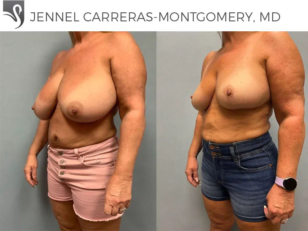 Before and After Image: Female Breast Reduction Case #24288 - left-front-oblique