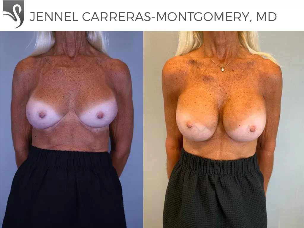 Before and After Image: Breast Revisions Case #75171
