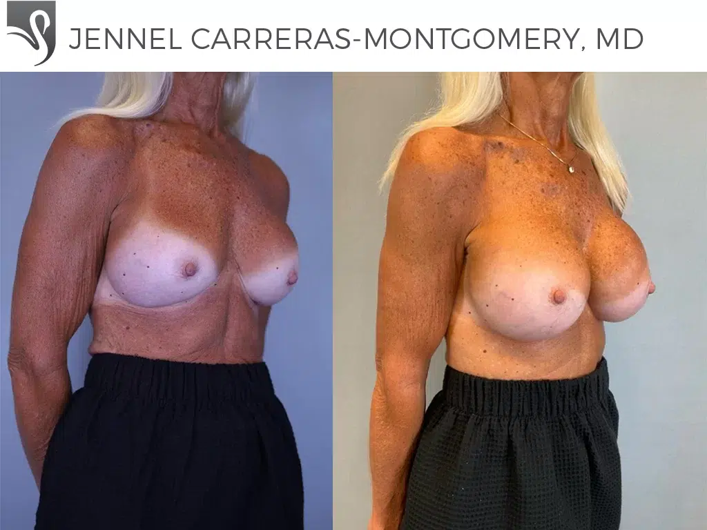 Before and After Image: Breast Revisions Case #75171 - right-front-oblique