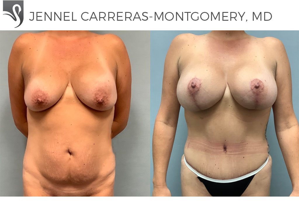 Before and After Image: Mommy Makeover Case #75233 - front