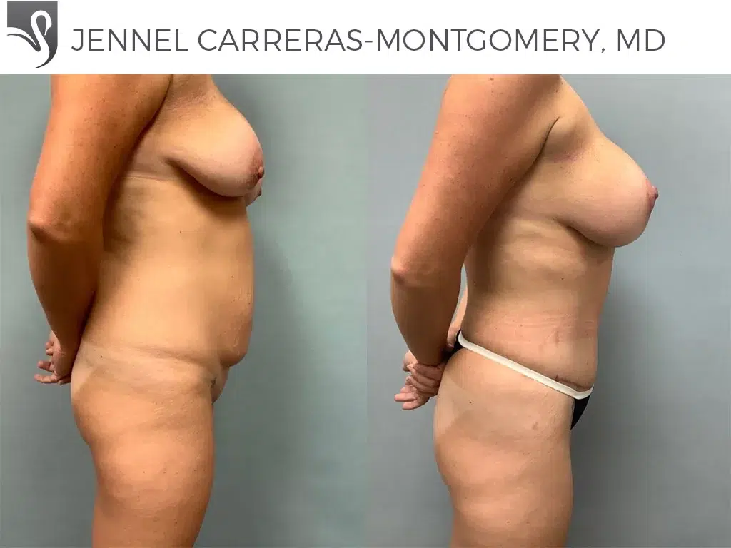 Before and After Image: Mommy Makeover Case #75233 - right-side
