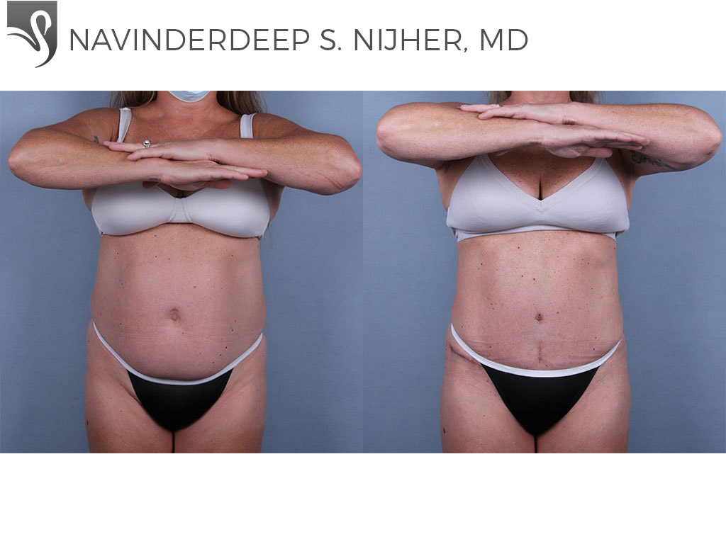 Before and After Image: Abdominoplasty (Tummy Tuck) Case #75434 - front
