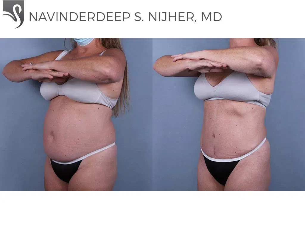 Before and After Image: Abdominoplasty (Tummy Tuck) Case #75434 - left-front-oblique