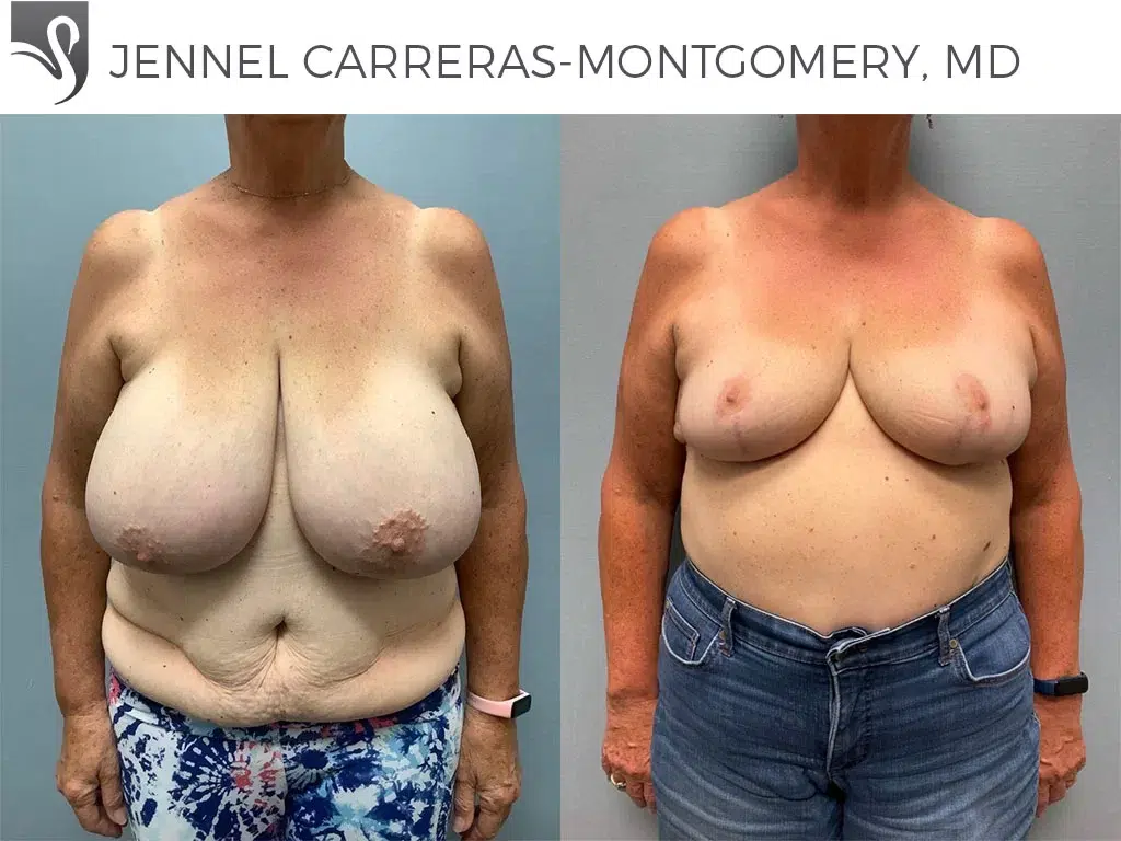 Before and After Image: Female Breast Reduction Case #75453 - front