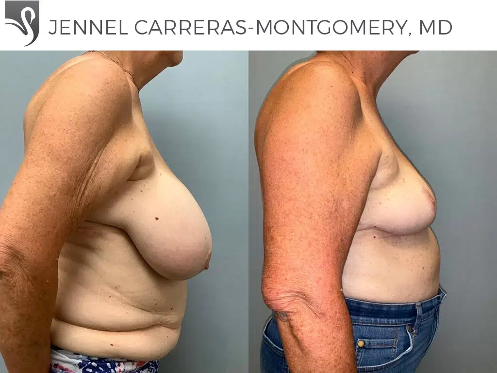 Before and After Image: Female Breast Reduction Case #75453 - right-side