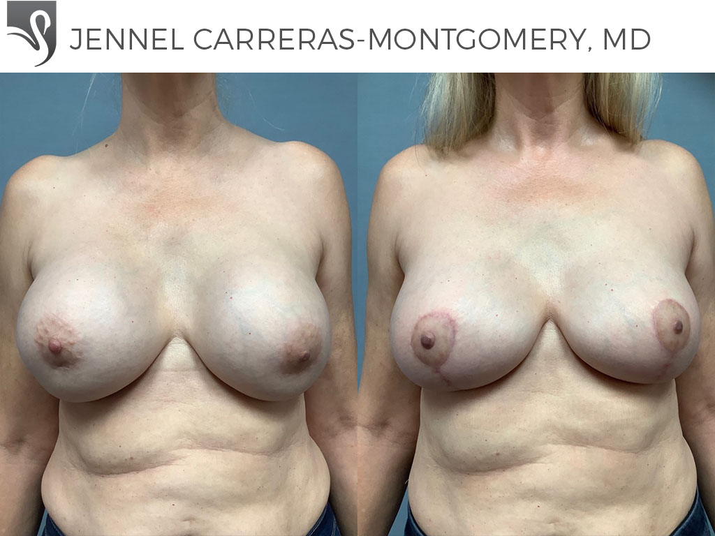 Before and After Image: Breast Revisions Case #75463