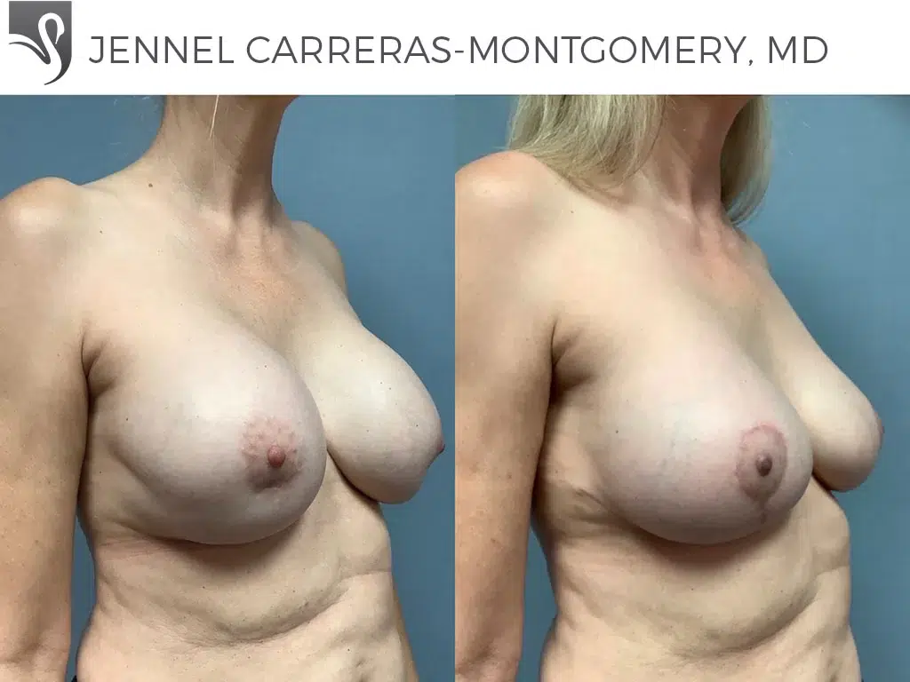 Before and After Image: Breast Revisions Case #75463 - right-front-oblique