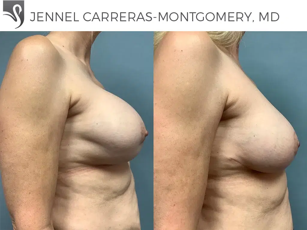 Before and After Image: Breast Revisions Case #75463 - right-side