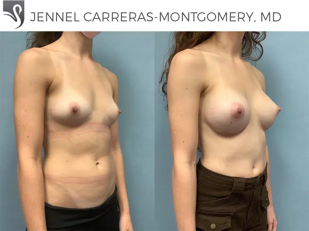 Before and After Image: Breast Augmentation Case #75579 - right-front-oblique
