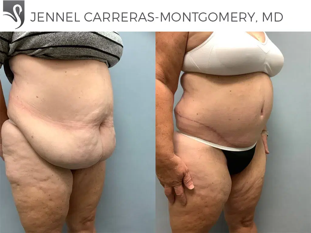 Before and After Image: Post-Bariatric Surgery Case #75668 - right-front-oblique