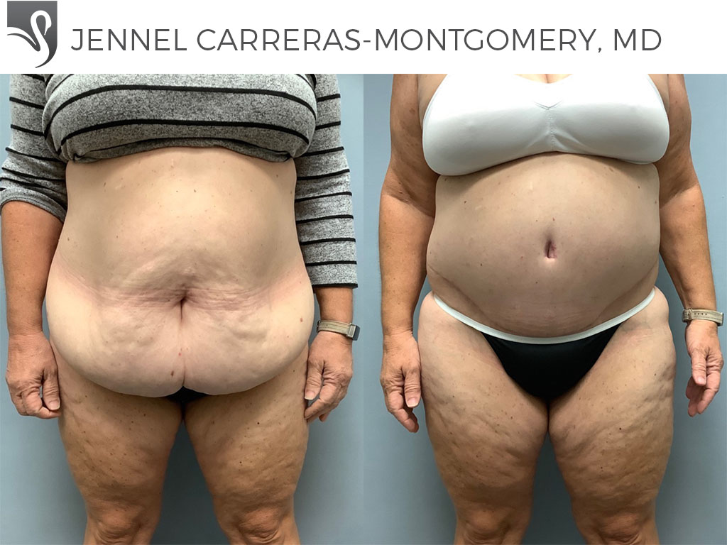Before and After Image: Post-Bariatric Surgery Case #75668