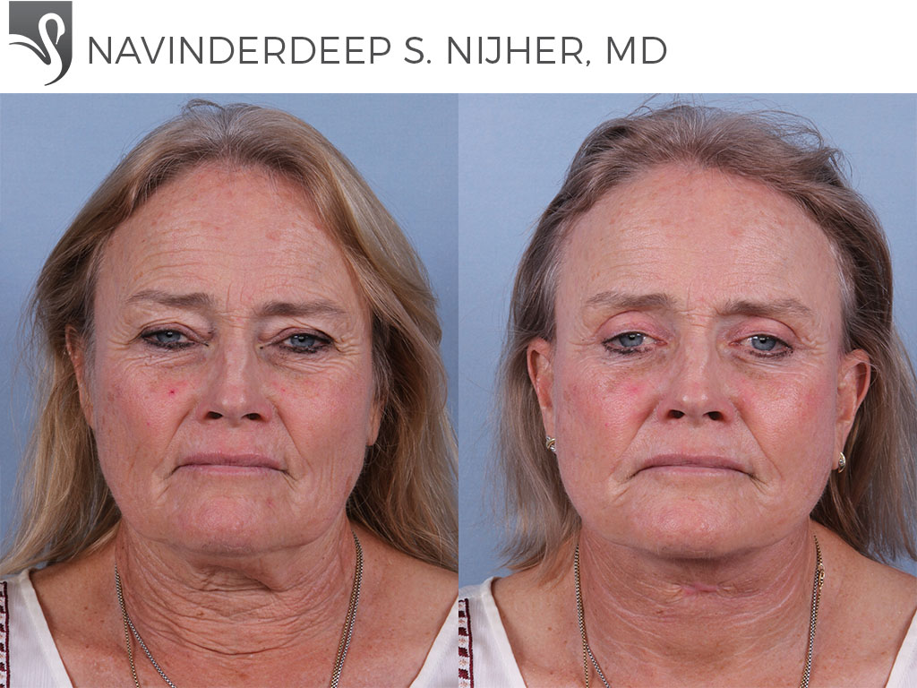 Before and After Image: Face Lift Case #75922 - front