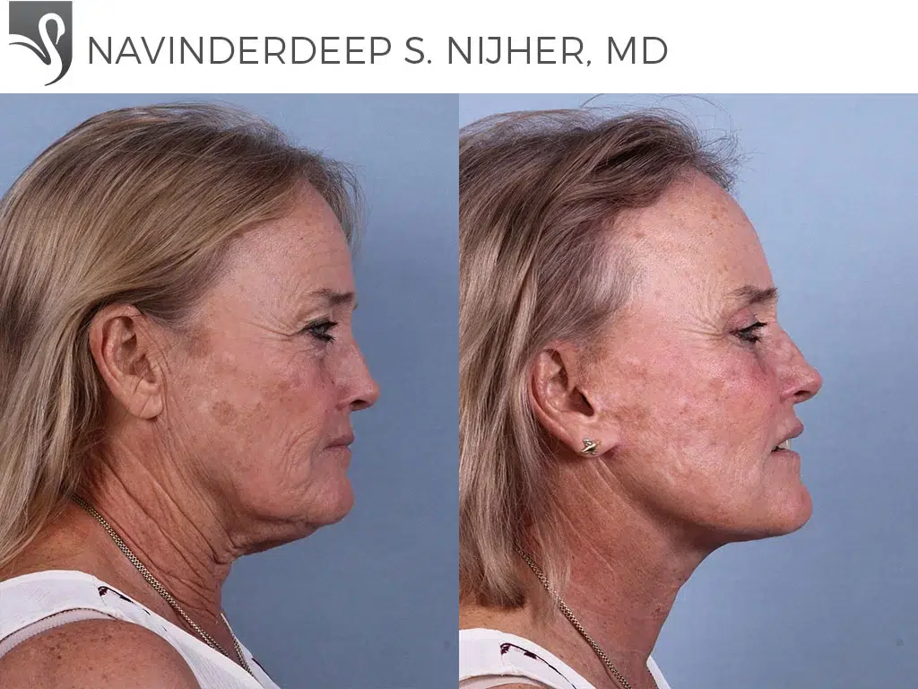 Before and After Image: Face Lift Case #75922 - right-side