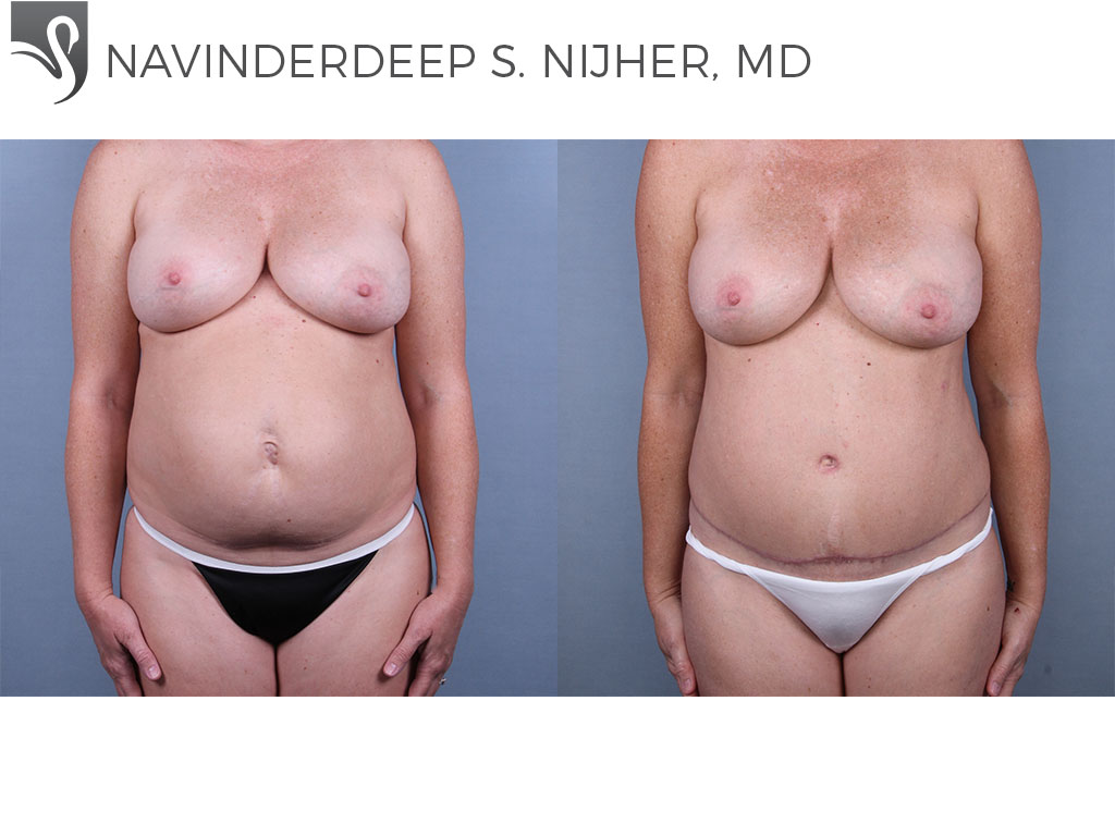 Before and After Image: Abdominoplasty (Tummy Tuck) Case #76202 - front