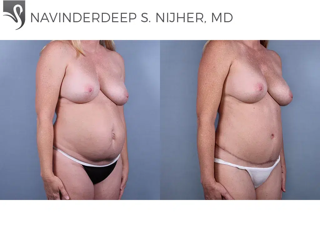 Before and After Image: Abdominoplasty (Tummy Tuck) Case #76202 - right-front-oblique