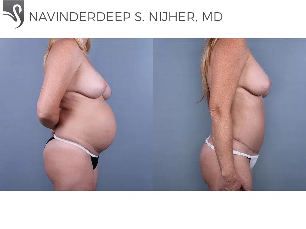 Before and After Image: Abdominoplasty (Tummy Tuck) Case #76202 - right-side