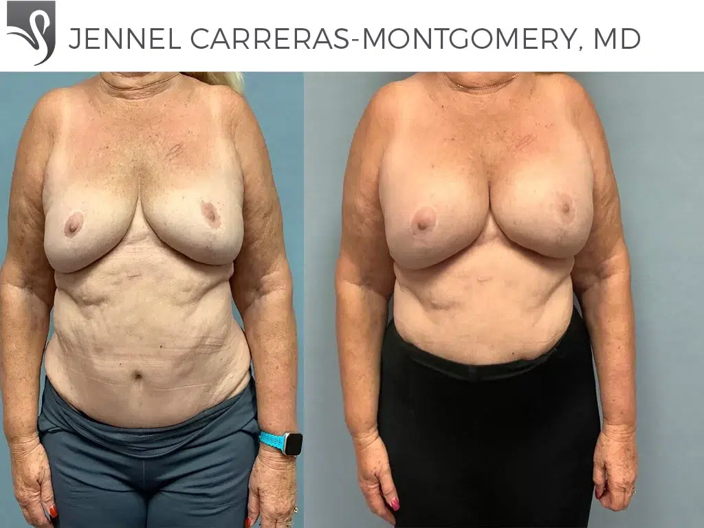Before and After Image: Breast Augmentation Case #76300 - front