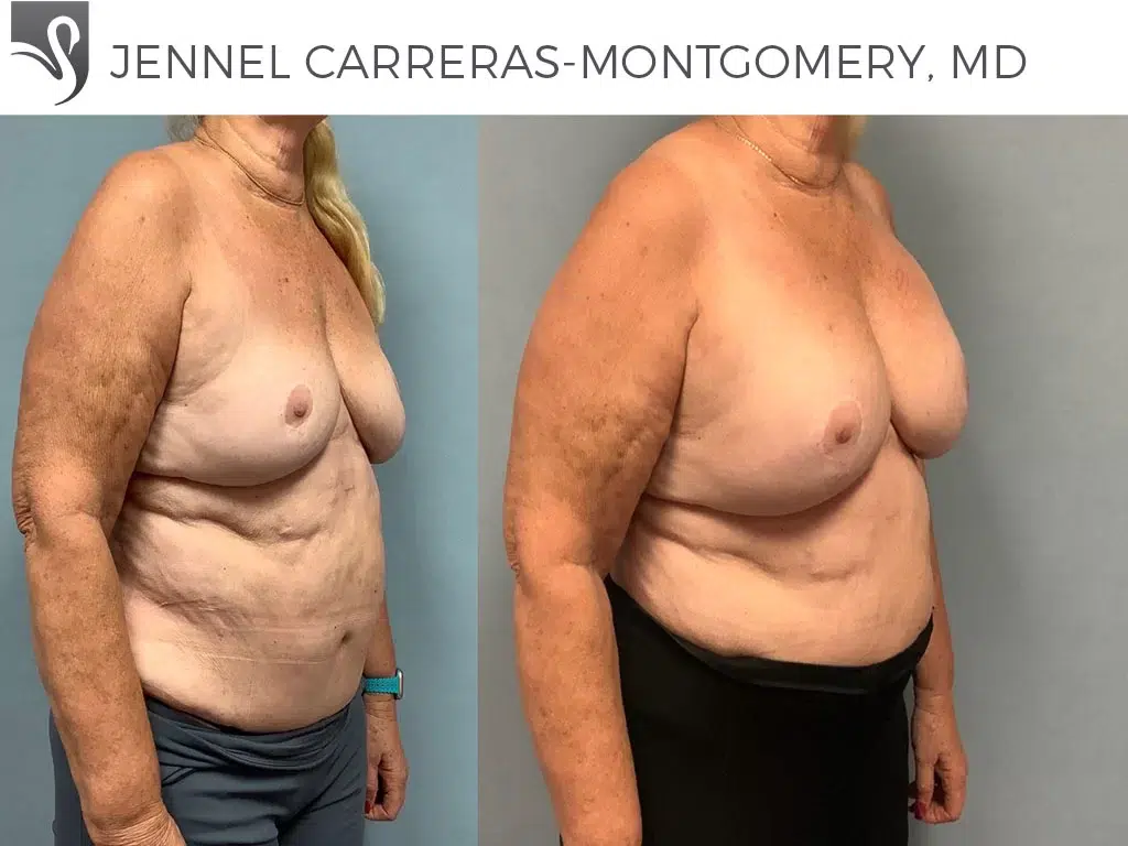 Before and After Image: Breast Augmentation Case #76300 - right-front-oblique