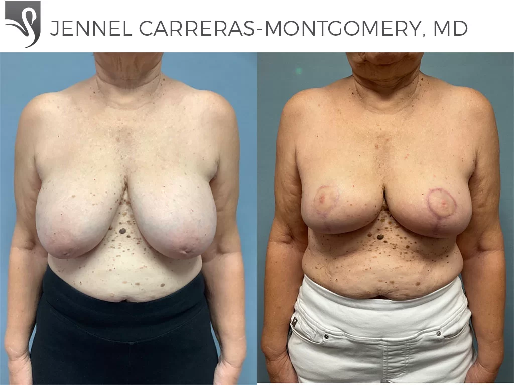 Before and After Image: Breast Reconstruction Case #76302 - front