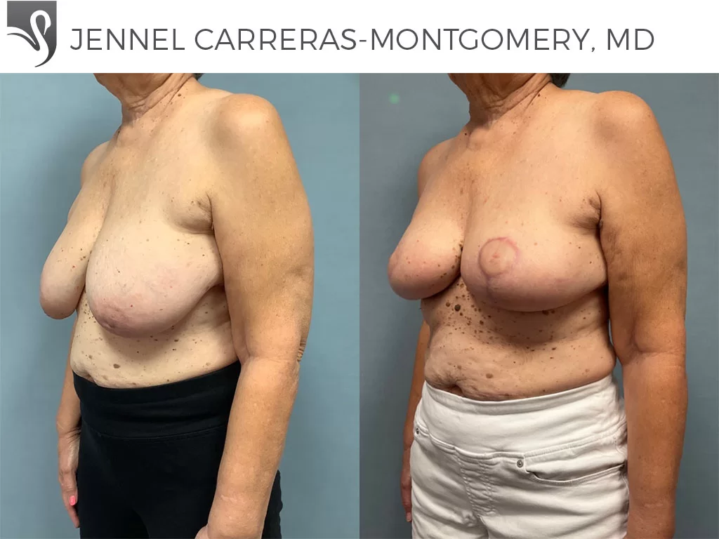 Before and After Image: Breast Reconstruction Case #76302 - left-front-oblique
