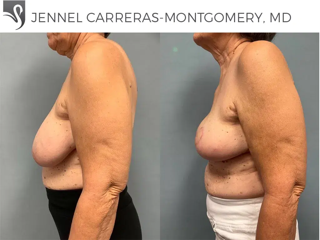 Before and After Image: Breast Reconstruction Case #76302 - left-side