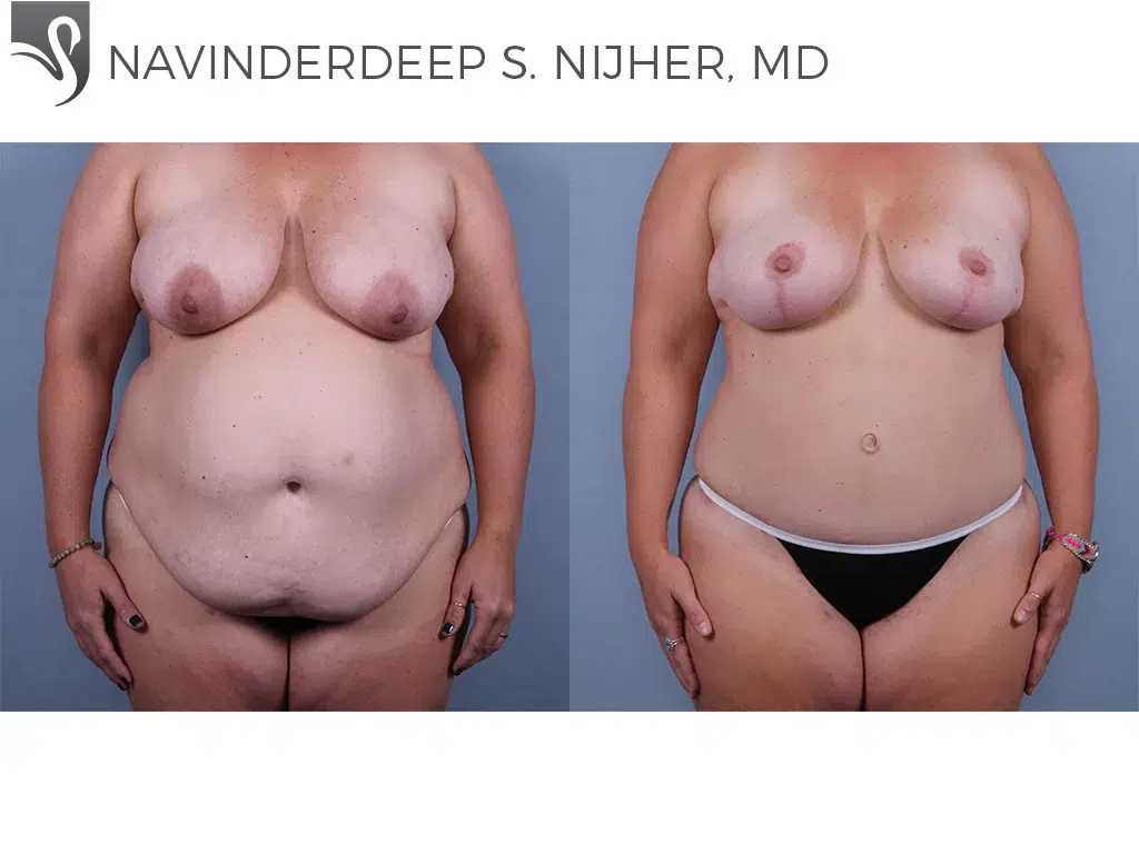 Before and After Image: Abdominoplasty (Tummy Tuck) Case #76444