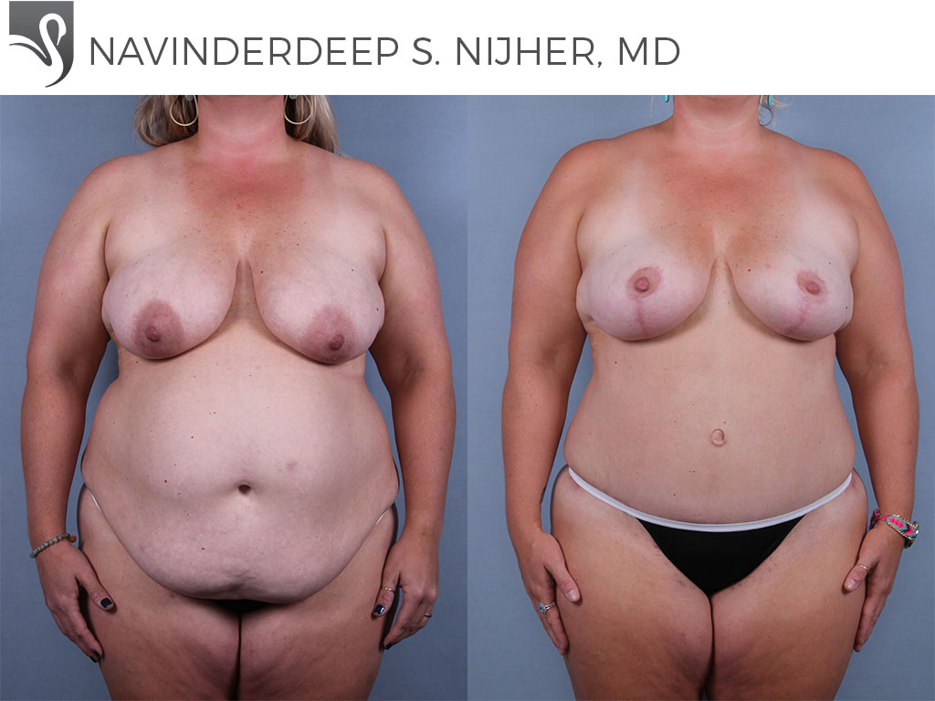 Before and After Image: Mommy Makeover Case #76444