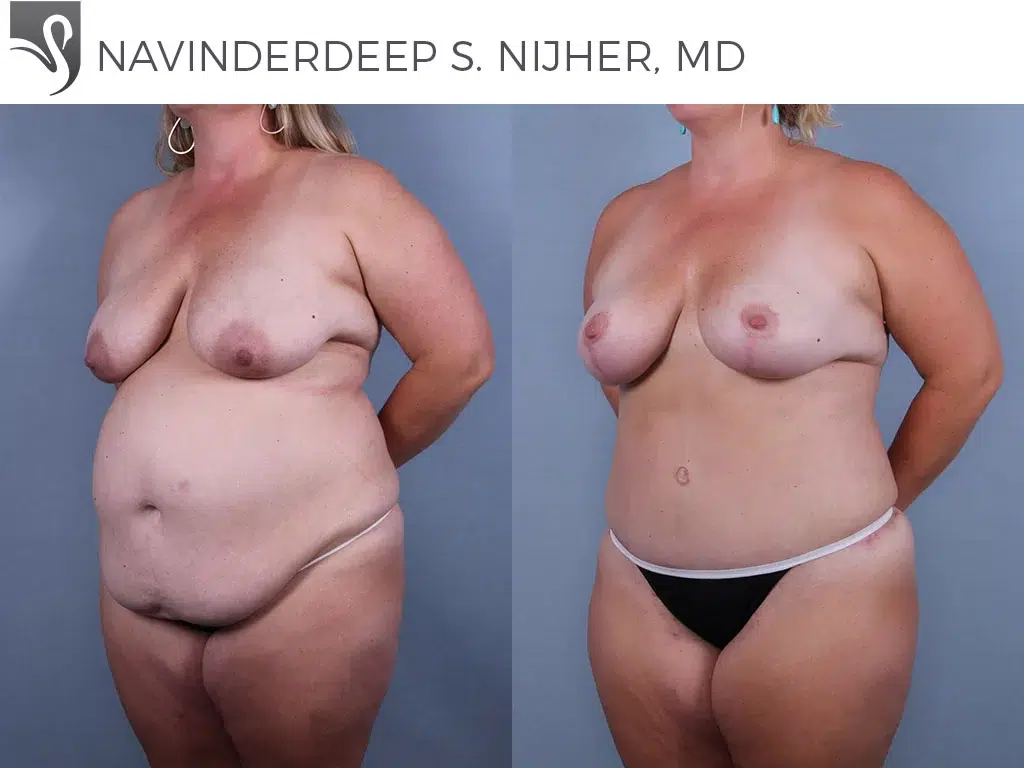 Before and After Image: Mommy Makeover Case #76444 - left-front-oblique