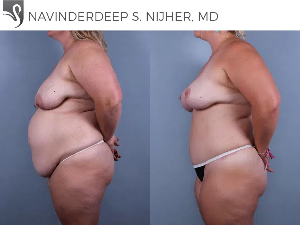 Before and After Image: Mommy Makeover Case #76444 - left-side