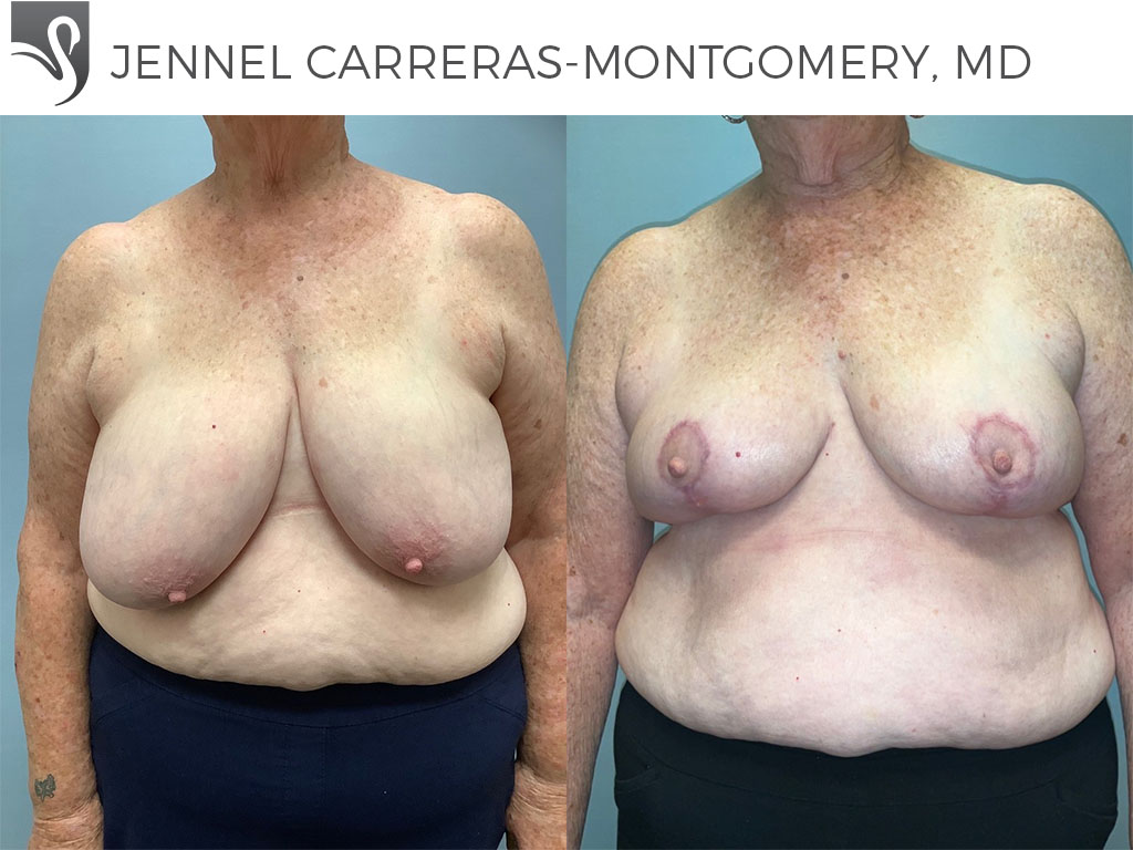 Before and After Image: Female Breast Reduction Case #76779 - front