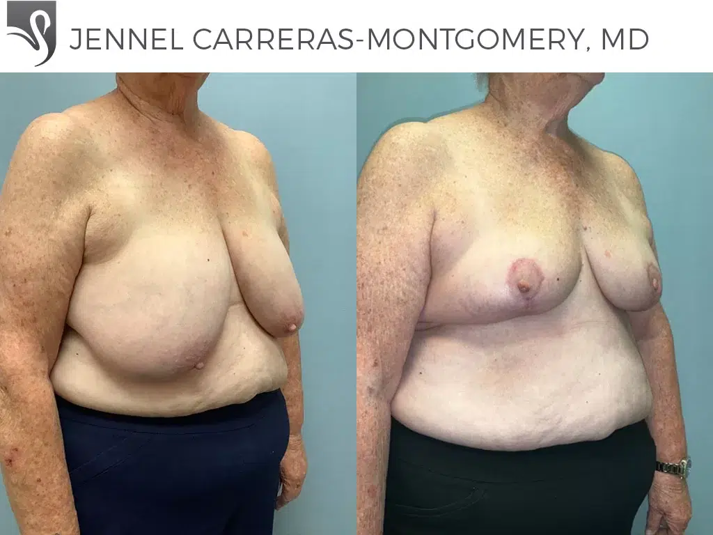 Before and After Image: Female Breast Reduction Case #76779 - right-front-oblique