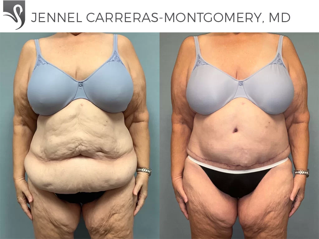 Before and After Image: Post-Bariatric Surgery Case #76807