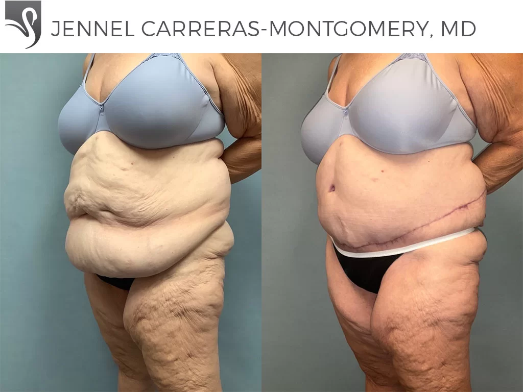 Before and After Image: Post-Bariatric Surgery Case #76807 - left-front-oblique