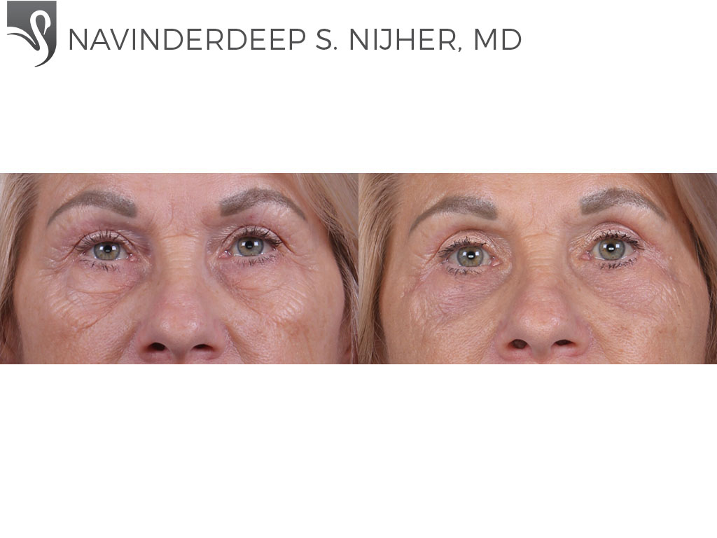 Before and After Image: Eyelid Surgery Case #76958 - front